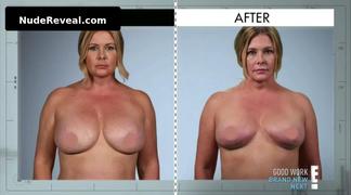 NICOLE EGGERT nude in Botched