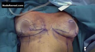 NICOLE EGGERT nude in Botched